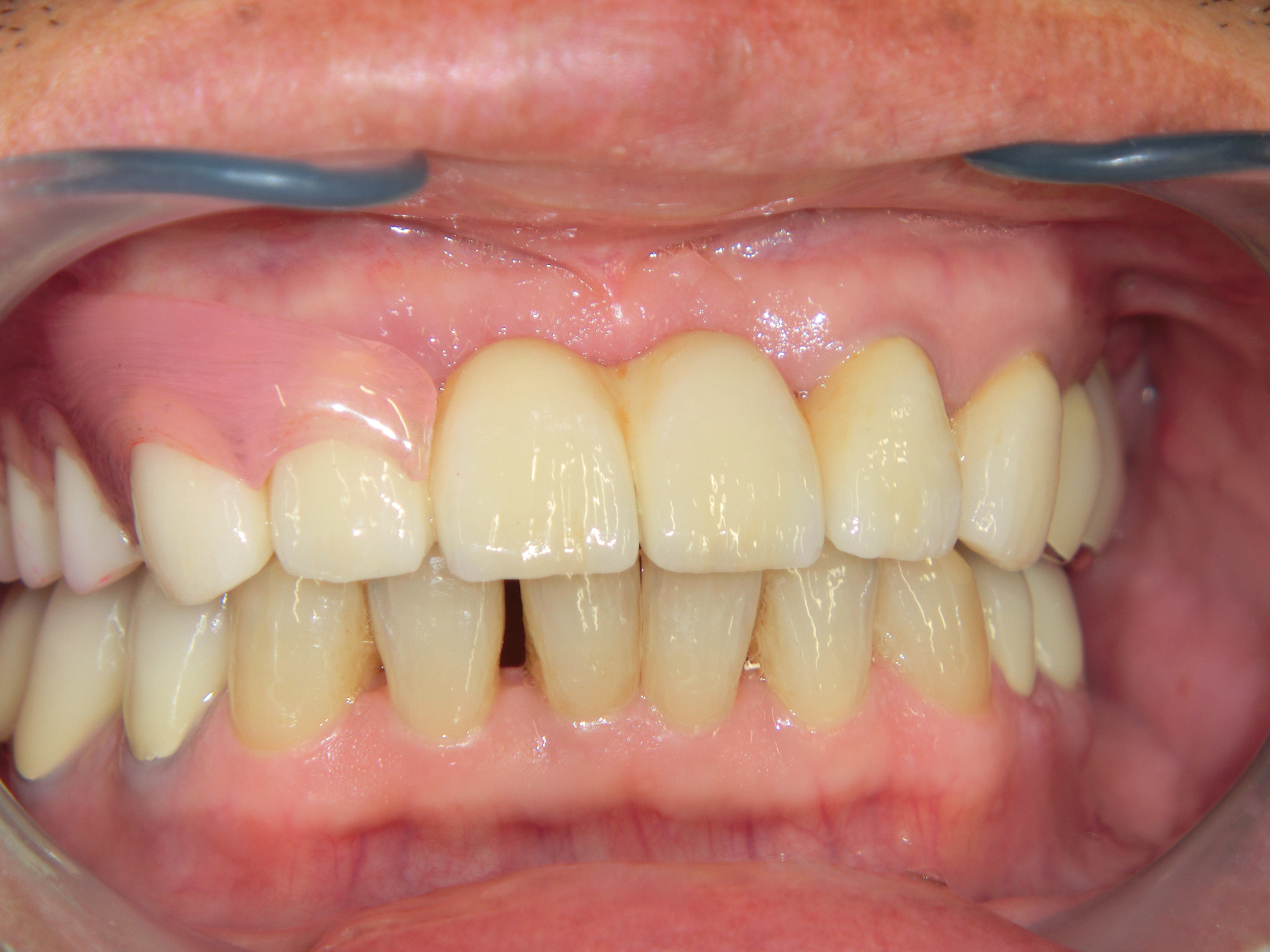 清藤歯科医院-入れ歯・義歯-コンビネーションデンチャー