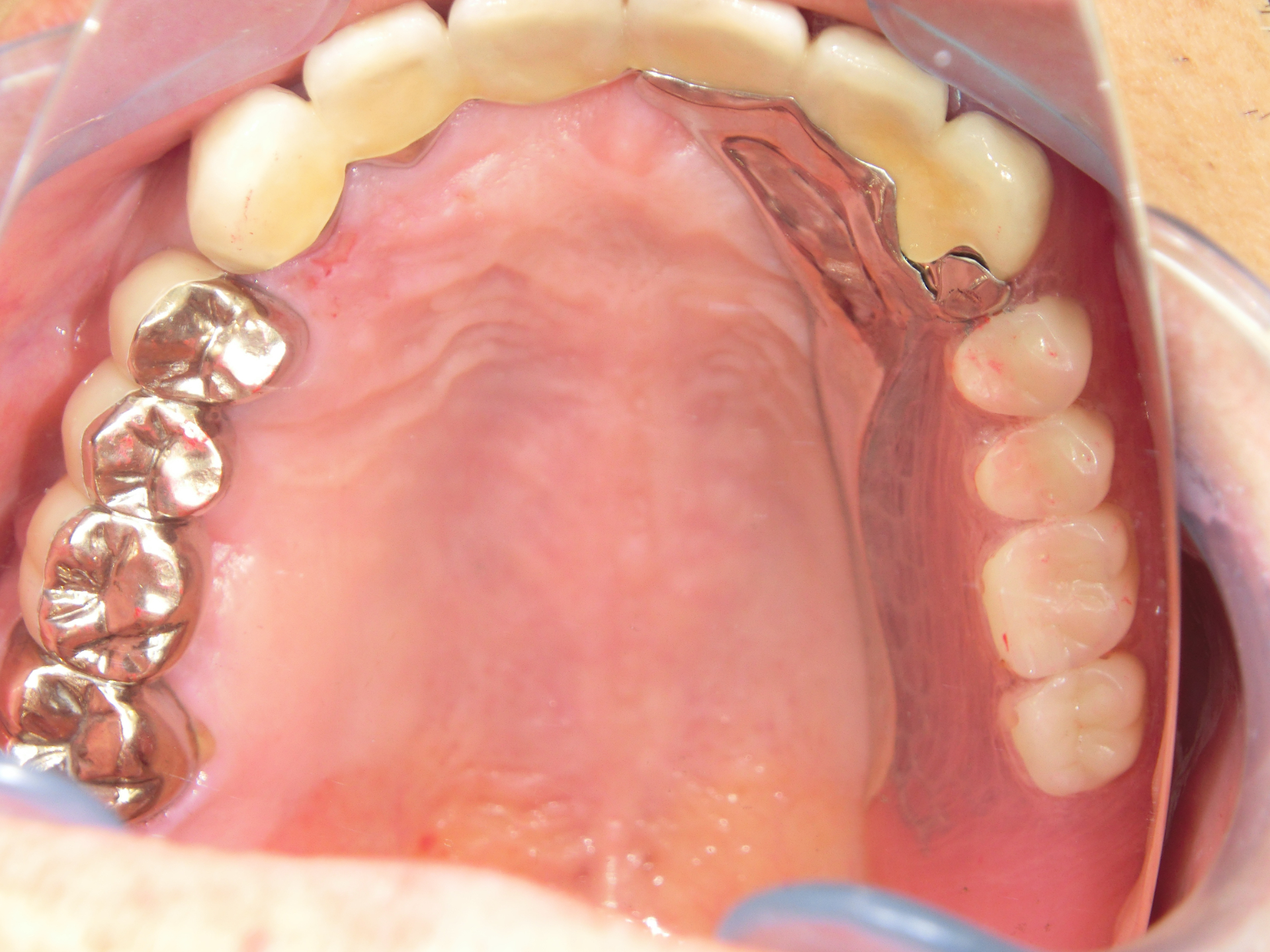 清藤歯科医院-入れ歯・義歯-コンビネーションデンチャー