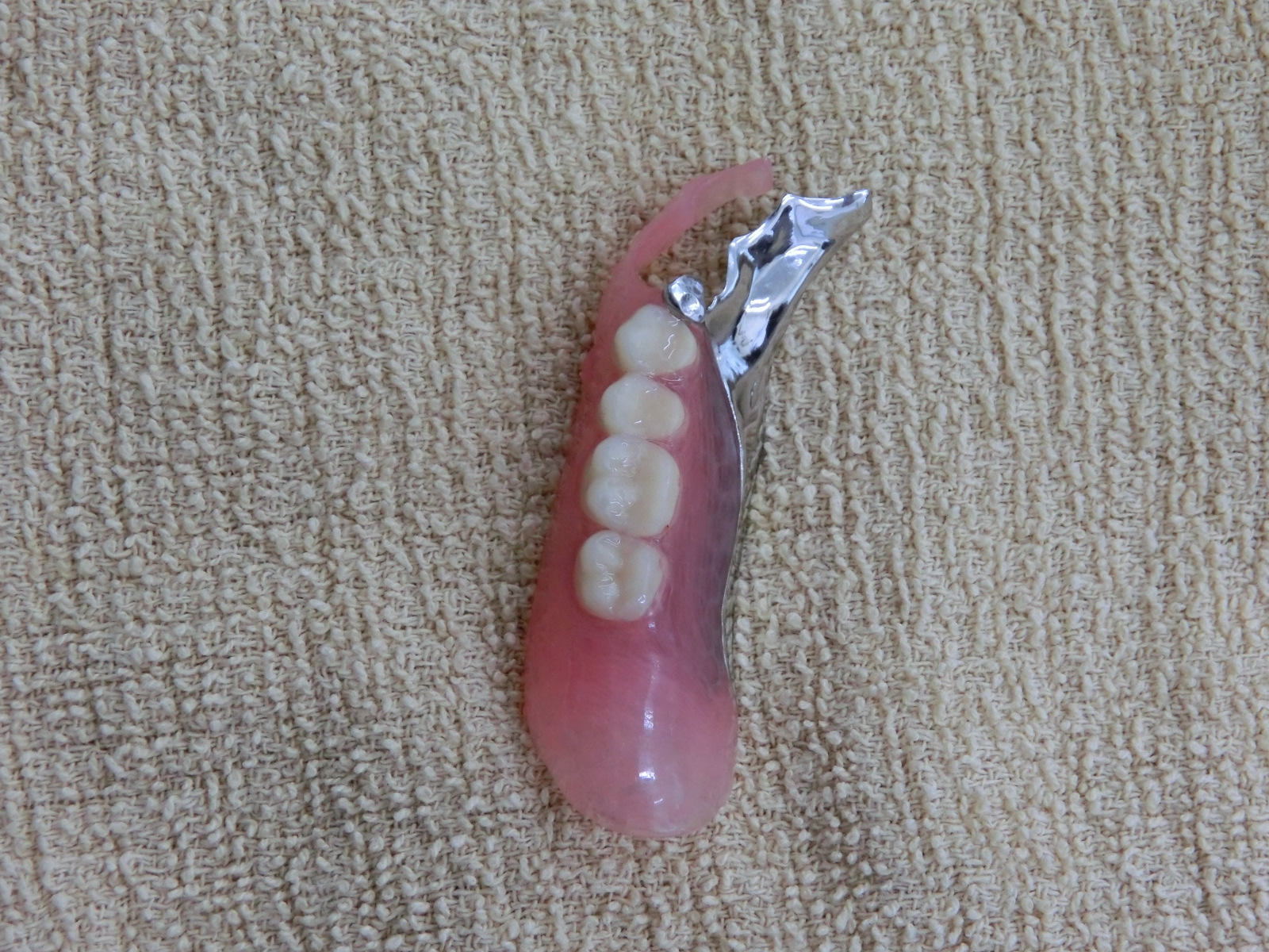 清藤歯科医院-入れ歯・義歯-コンビネーションデンチャー