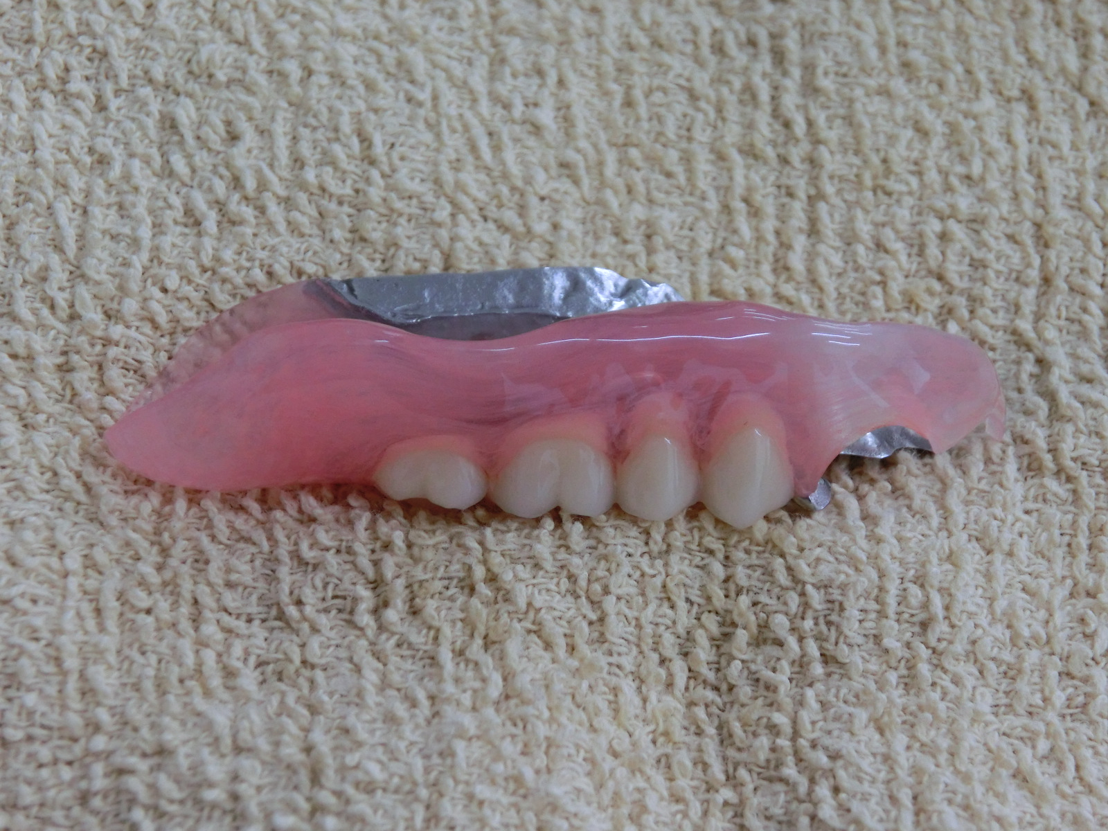 清藤歯科医院-入れ歯・義歯-コンビネーションデンチャー