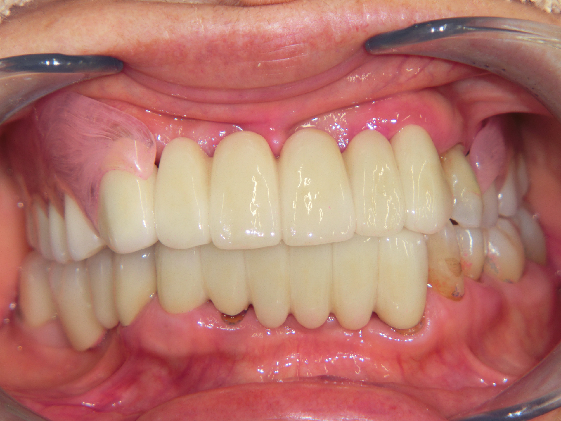 清藤歯科医院-入れ歯・義歯-コンビネーション義歯