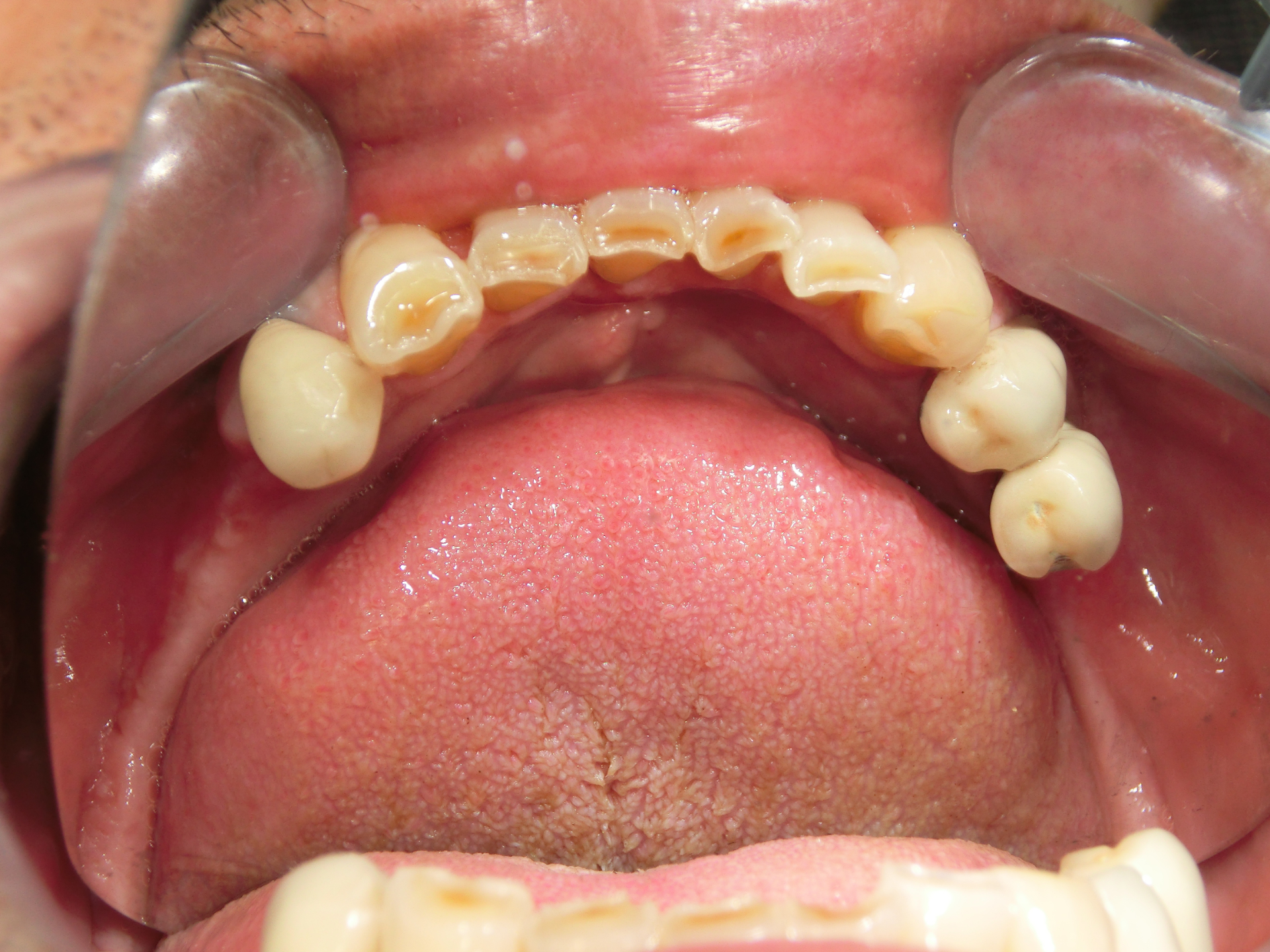 清藤歯科医院-インプラント