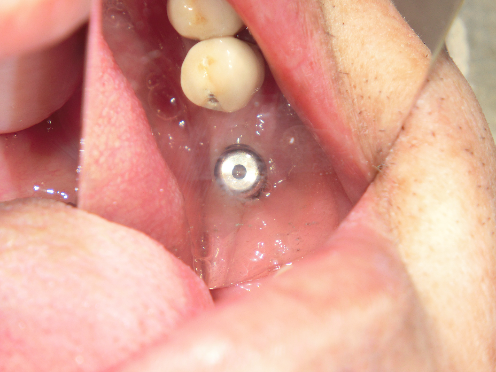 清藤歯科医院-インプラント