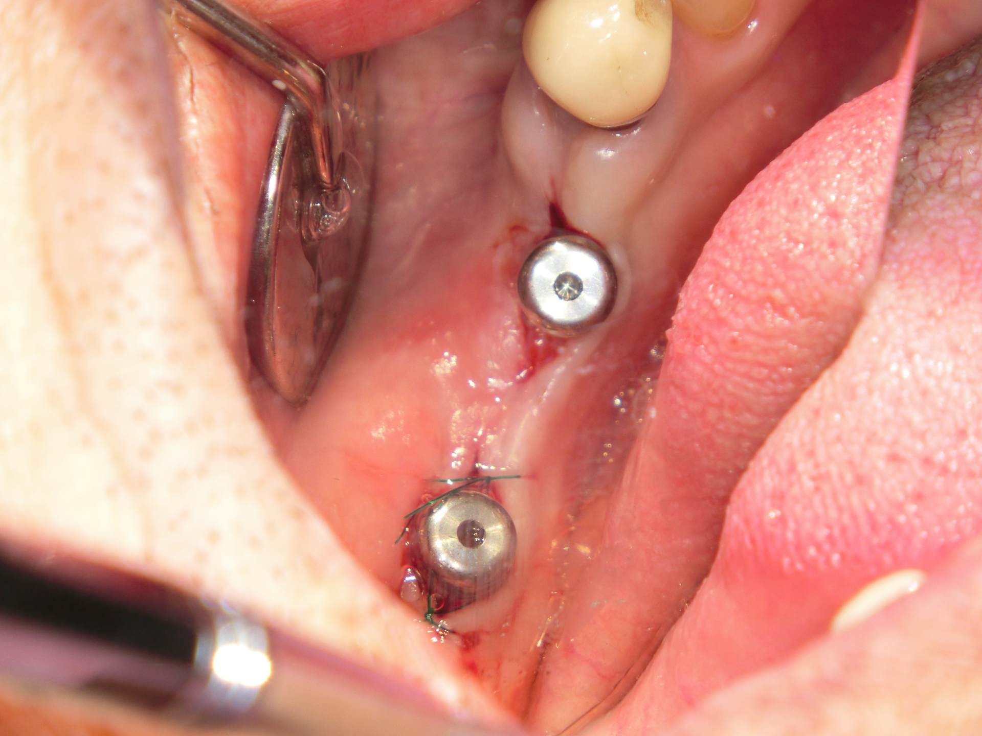 清藤歯科医院-インプラント