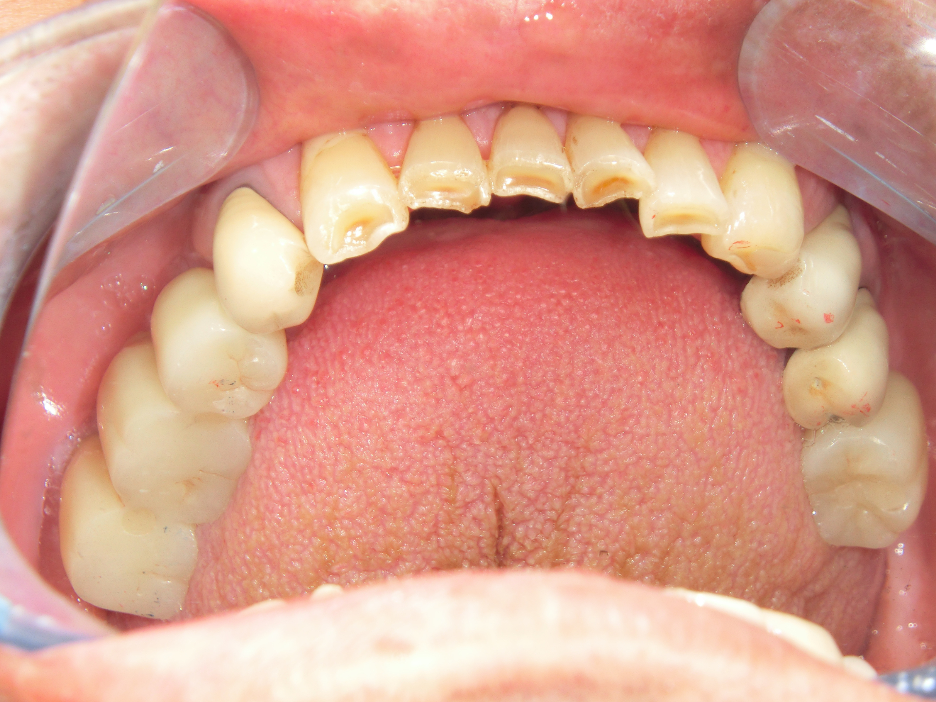 清藤歯科医院-インプラント