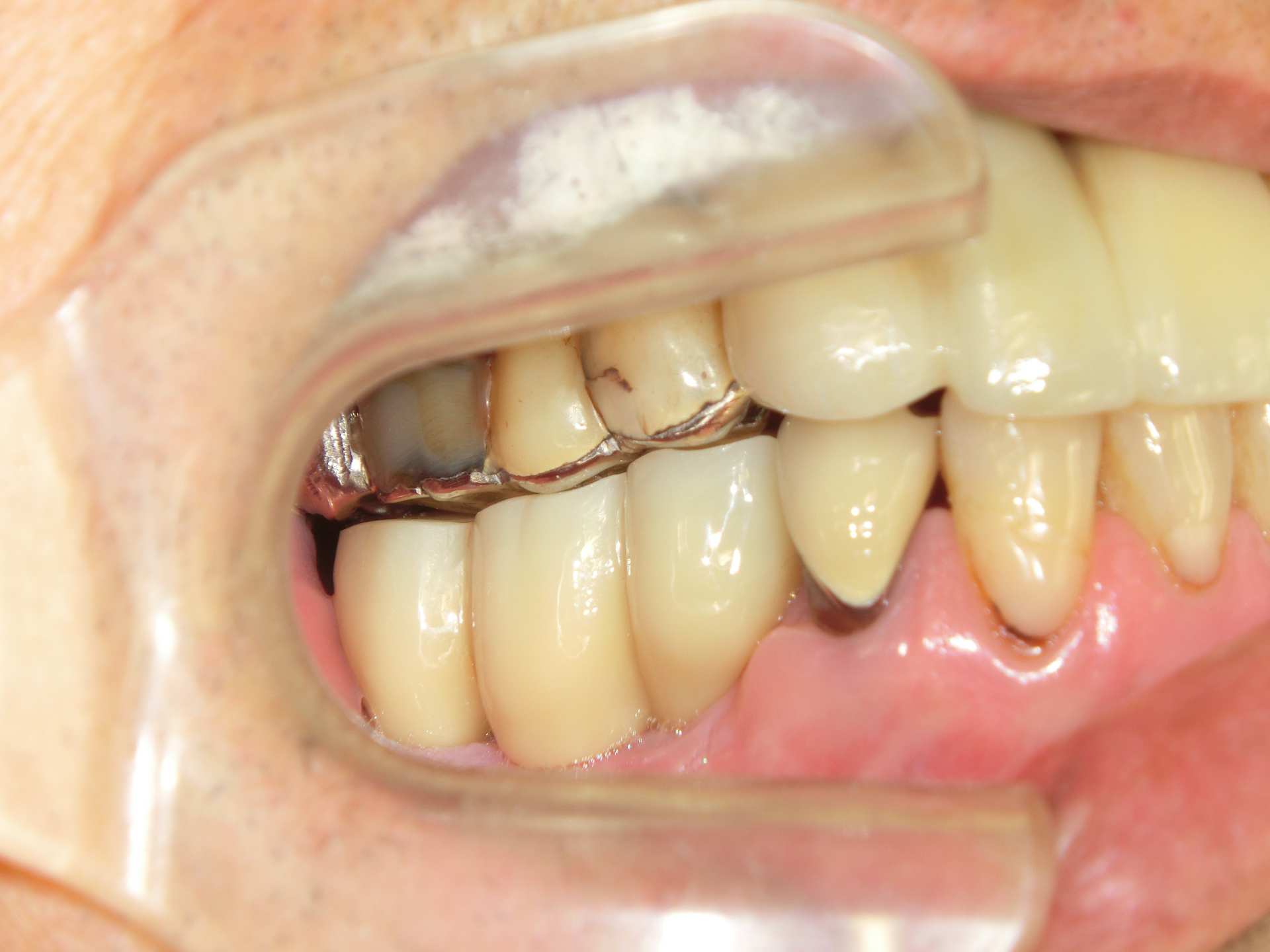 清藤歯科医院-インプラント