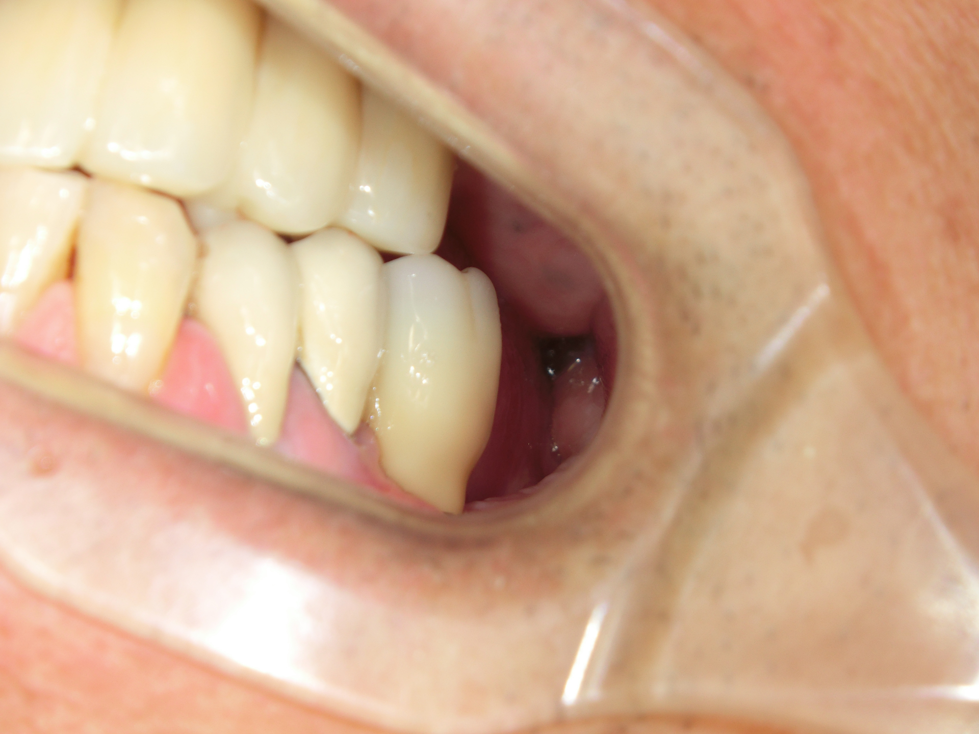 清藤歯科医院-インプラント