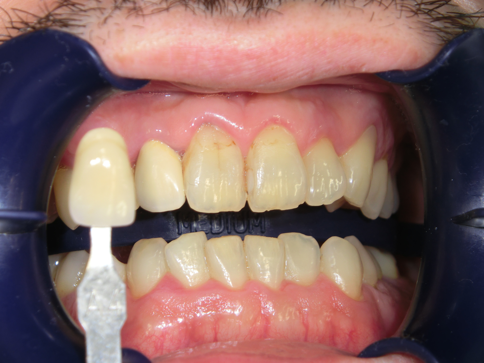 清藤歯科医院-ホワイトニング