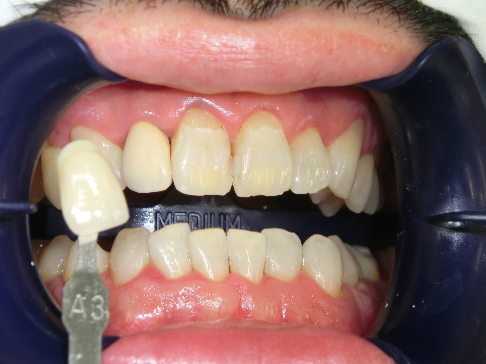 清藤歯科医院-ホワイトニング