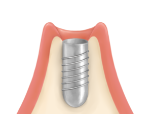 清藤歯科医院－インプラント
