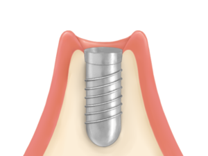 清藤歯科医院－インプラント