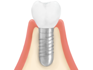 清藤歯科医院－インプラント