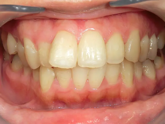 清藤歯科医院－ホワイトニング