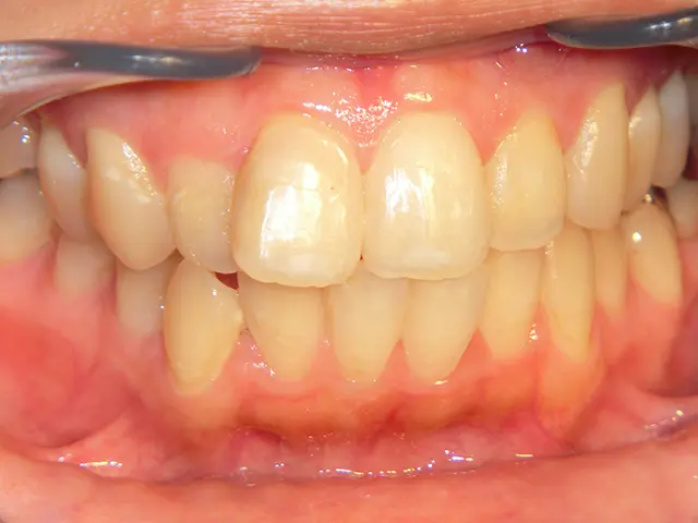 清藤歯科医院－ホワイトニング