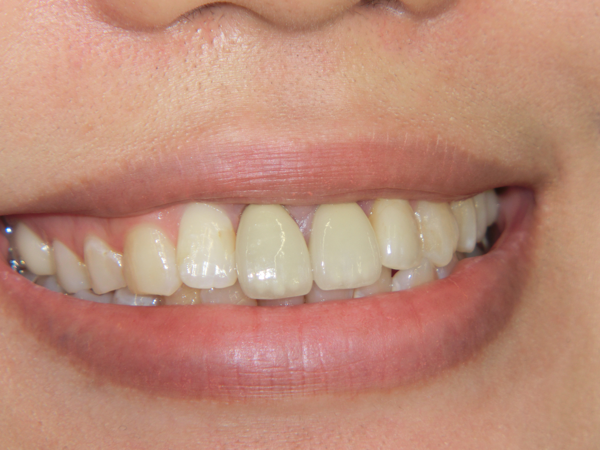 清藤歯科医院-審美歯科-e-max