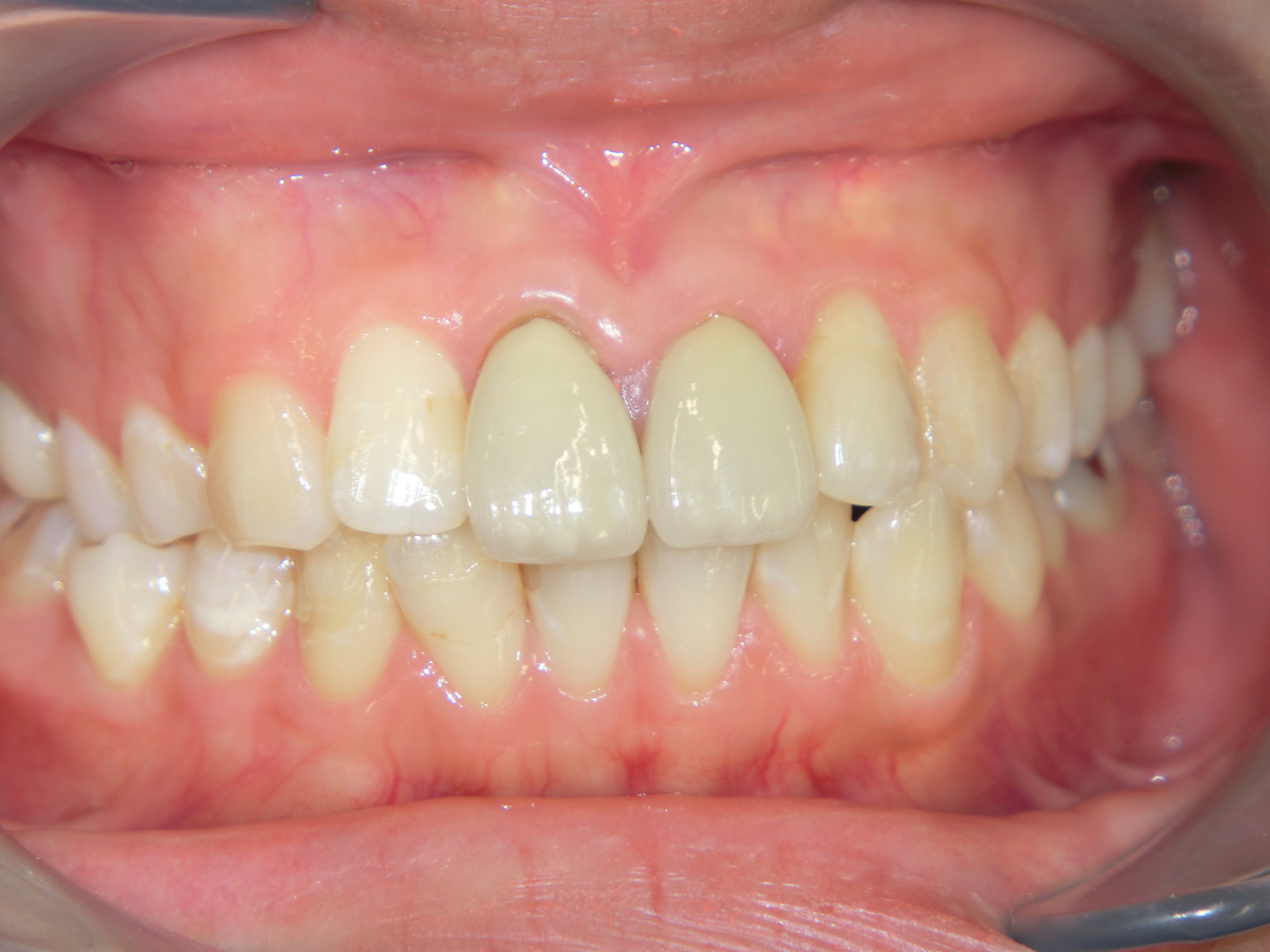 清藤歯科医院-審美歯科-e-max