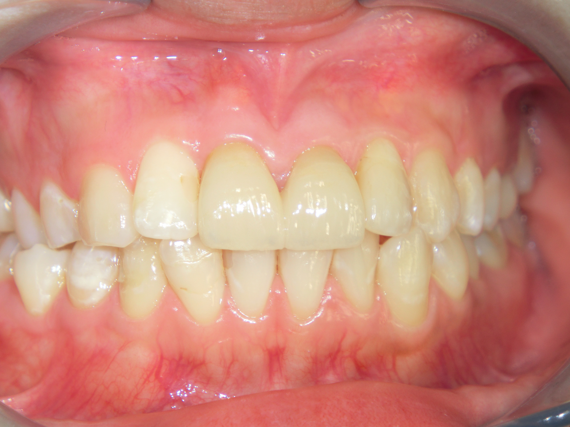 清藤歯科医院-審美歯科-e-max